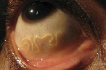 У жінки з ока дістали 12-сантиметрового паразита