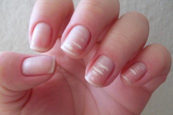 Чому виникають білі плями на нігтях