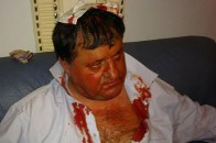 Лікарі прооперували БЮТівця, якому розбили голову під час бійки в Раді