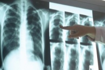 На Волині побоюються епідемії туберкульозу