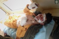 Опіки очей та рвані рани рук, або як вдалося вижити добровольцю з Волині ФОТО