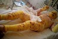 Неякісна солдатська форма ЗСУ розплавилася прямо на бійцях - волонтер