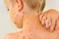 В Україні за тиждень на кір захворіли 800 людей