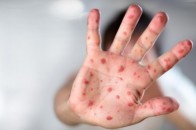 У Львові від кору померла трирічна дитина