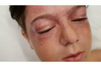 Підліток дістав крововилив у очі, коли повторив трюк з YouTube (фото, відео)