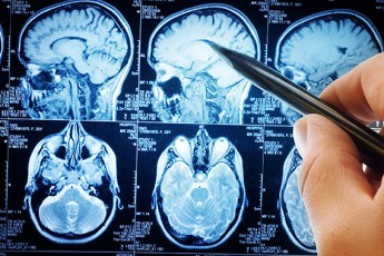Як розпізнати симптоми раку мозку і хто в групі ризику: українські лікарі дали відповідь