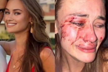Українську модель ще з трьома жінками жорстоко побили на пляжі у Туреччині