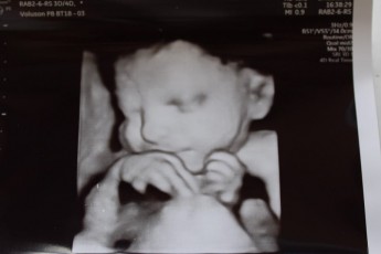 У Ковелі УЗД-апарат може зробити фото дитини ще до народження
